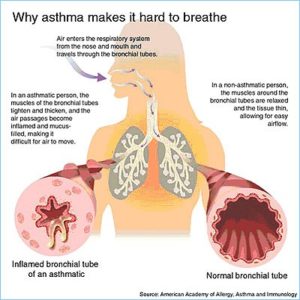 asthma