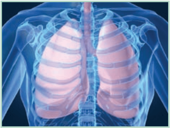 Atelectasis-or-Colapsed-Lung