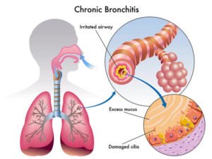 Bronchitis