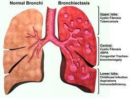 Brochiectas-Lungs