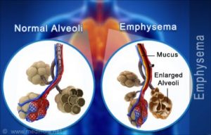 emphysema