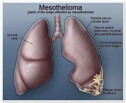 terminal peritoneal mesothelioma