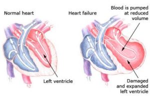 360464-Left-Sided-Heart-Failure