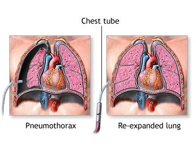 Repair-Pneumothorax