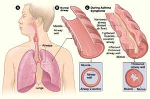 airway-walls